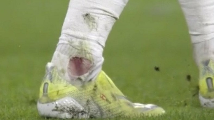 Pestone Esposito a Morata: Pirlo svela le condizioni dello spagnolo 36 morata caviglia