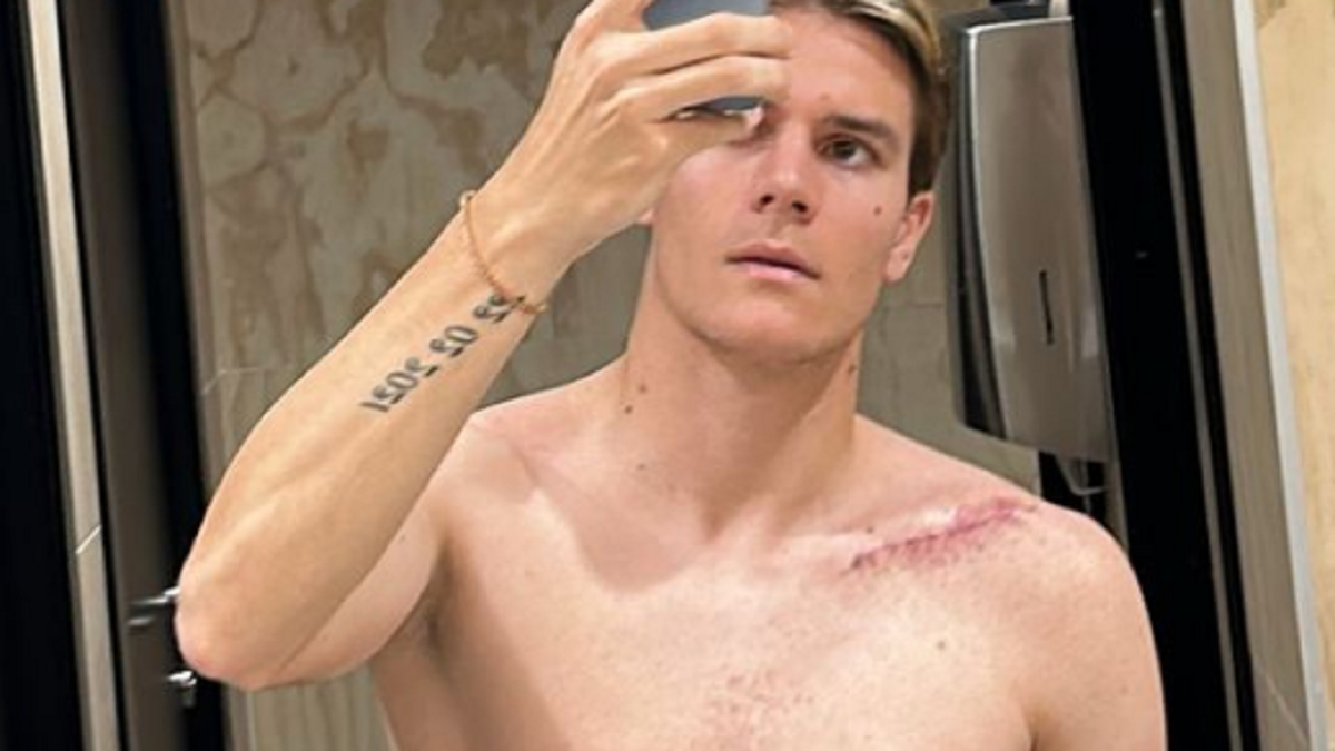 Fagioli, un mese dopo l'intervento: postata la FOTO della cicatrice 36 fagioli