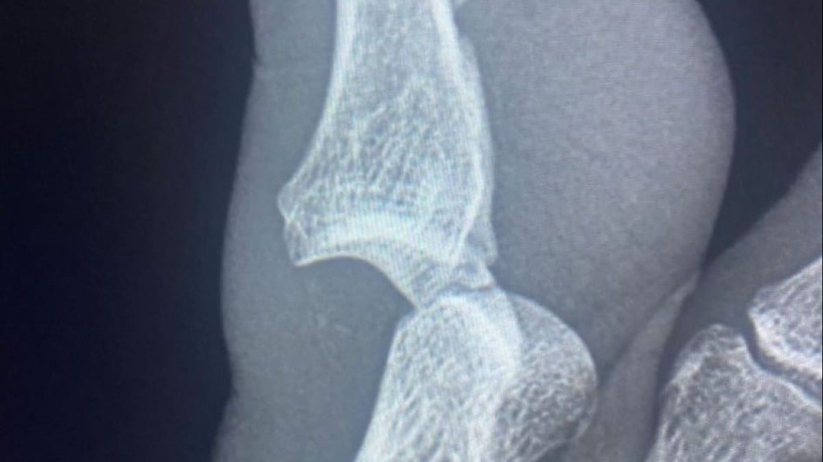 Rabiot dopo l'infortunio in Juve Frosinone: «Ecco com'è finita la duecentesima» - FOTO 36 rab jpg e1708887982374